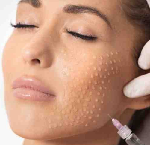 مراقبت های بعد از مزوتراپی